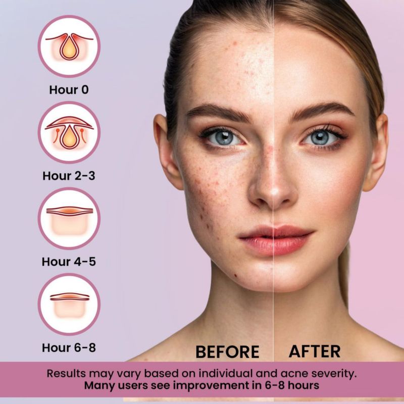 Parche antiacné Andlane 260 piezas Hidrocoloide