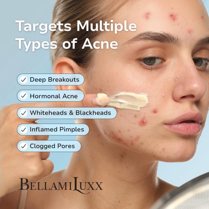 Tratamiento para el acné BellamiLuxx 100 ml Ácido Salicílico y árbol de té