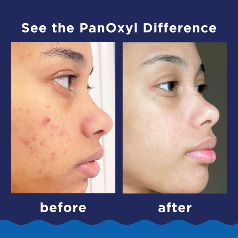 Limpiador facial PanOxyl Acne Foaming con peróxido de benzoilo 10% 90 ml