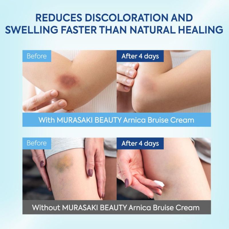 Crema para moretones Murasaki Beauty Arnica Extra Strength 120 ml