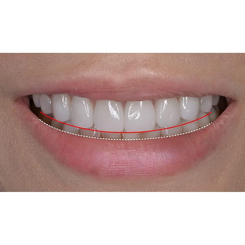 Carillas dentales sowsmile Comfort Fit Flex Molde