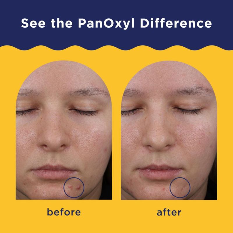 Máscara facial de acné PanOxyl 85 g 5 % azufre para rostro