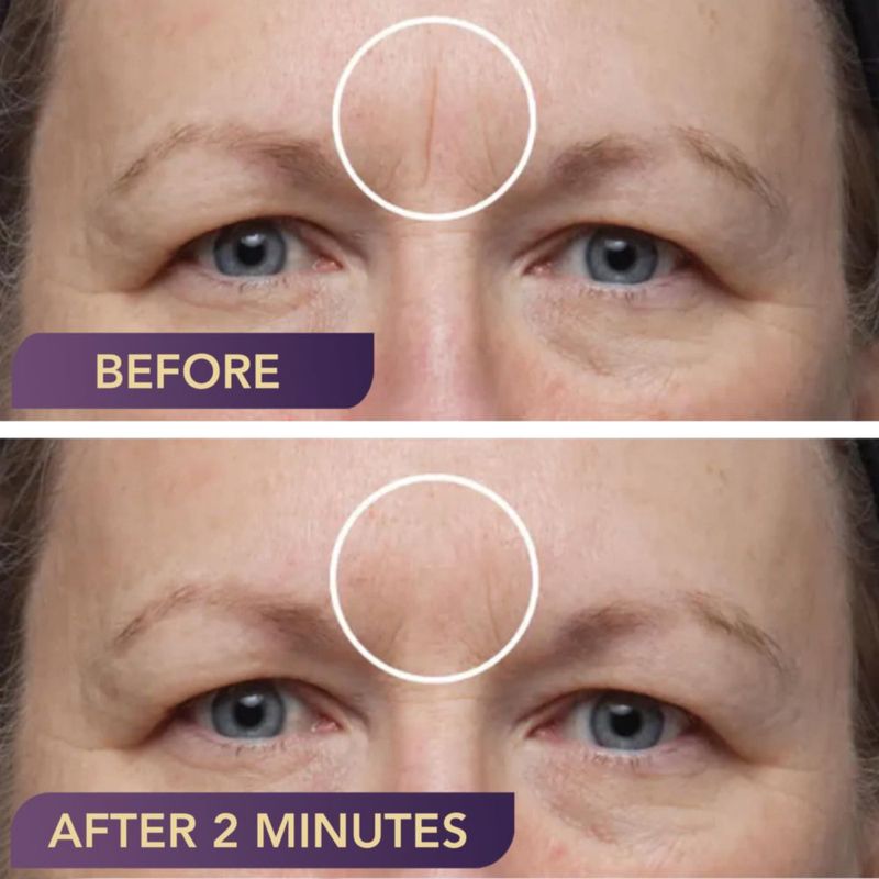 Relleno de Cicatrices Dermaflage – Recarga de 4 Aplicadores