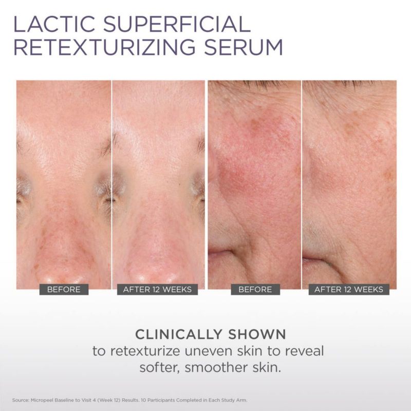 Suero Facial GLYTONE Micro-Peel Ácido Láctico 10% 30 ml