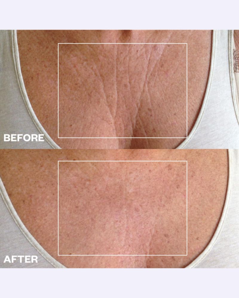 Parche antiarrugas para pecho Wrinkles Schminkles reutilizable - paquete de 1