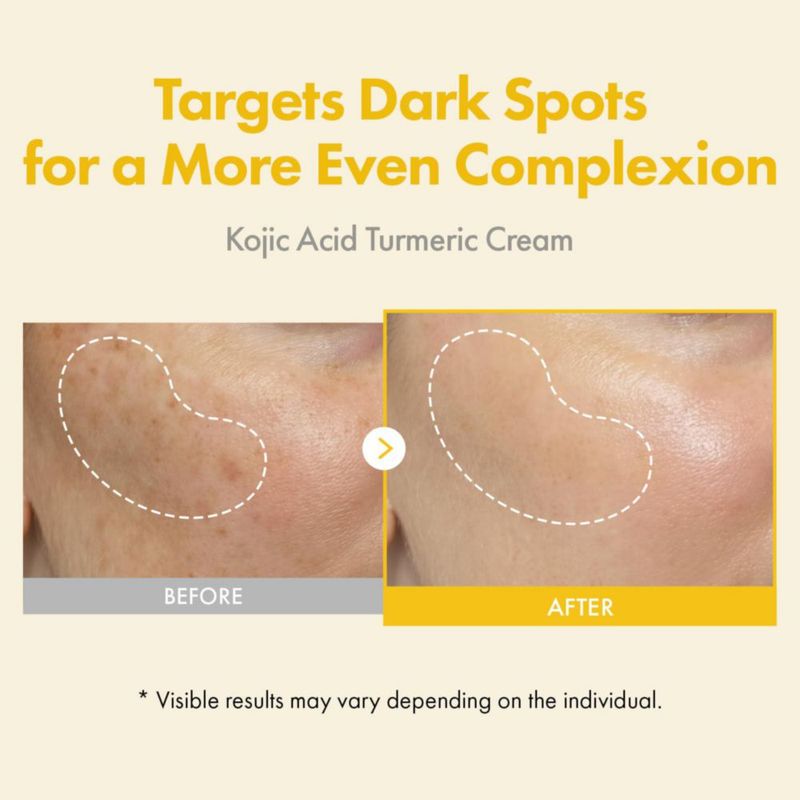 Crema TOSOWOONG con ácido kójico y cúrcuma 50 ml para manchas oscuras