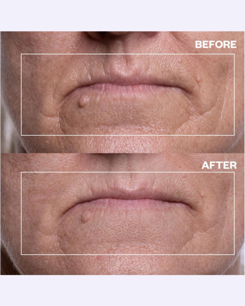Parche Antiedad Wrinkles Schminkles 2 Unidades Reutilizables