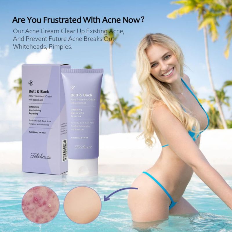 Crema para el tratamiento del acné Tobcharm Butt & Back con ácido azelaico