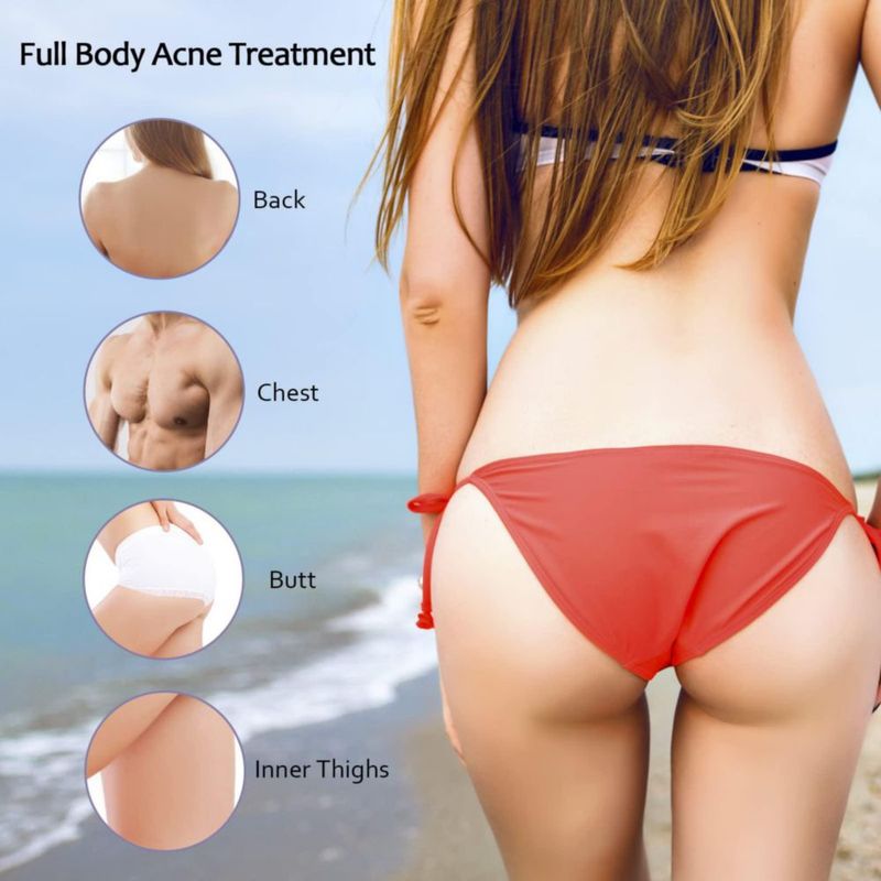 Crema para el tratamiento del acné Tobcharm Butt & Back con ácido azelaico