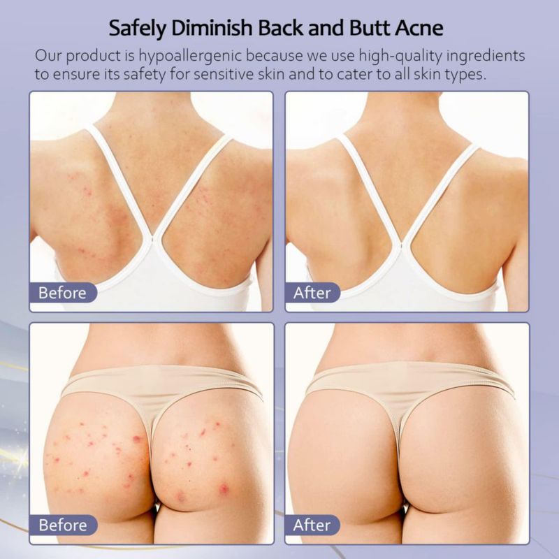 Crema para el tratamiento del acné Tobcharm Butt & Back con ácido azelaico